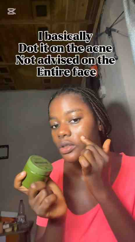 Sivoderm cream review for acne prone